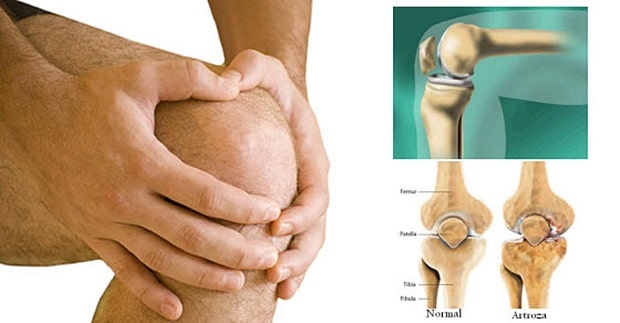 laktovi i koljena liječenje artroza
